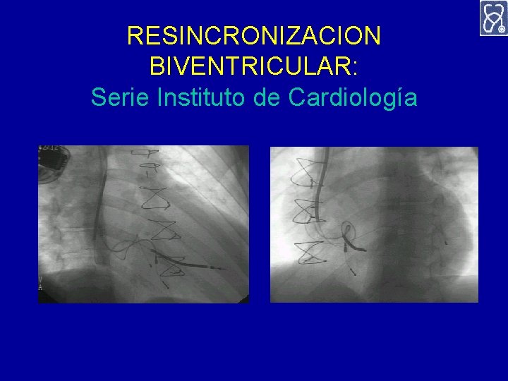 RESINCRONIZACION BIVENTRICULAR: Serie Instituto de Cardiología 