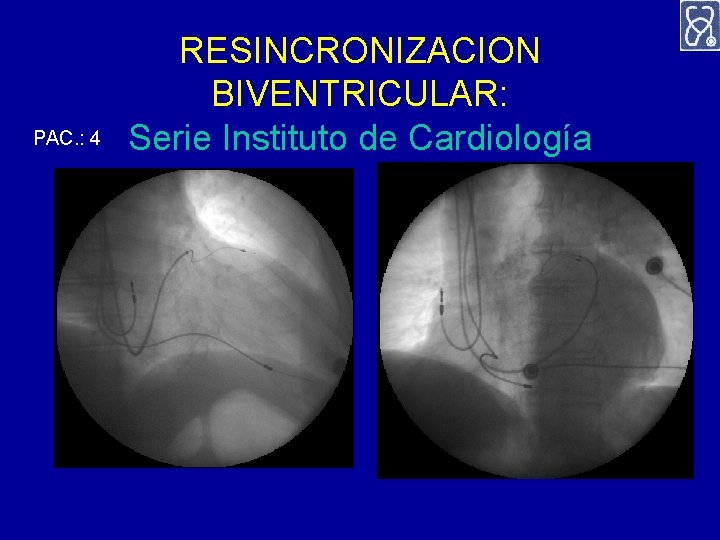 PAC. : 4 RESINCRONIZACION BIVENTRICULAR: Serie Instituto de Cardiología 