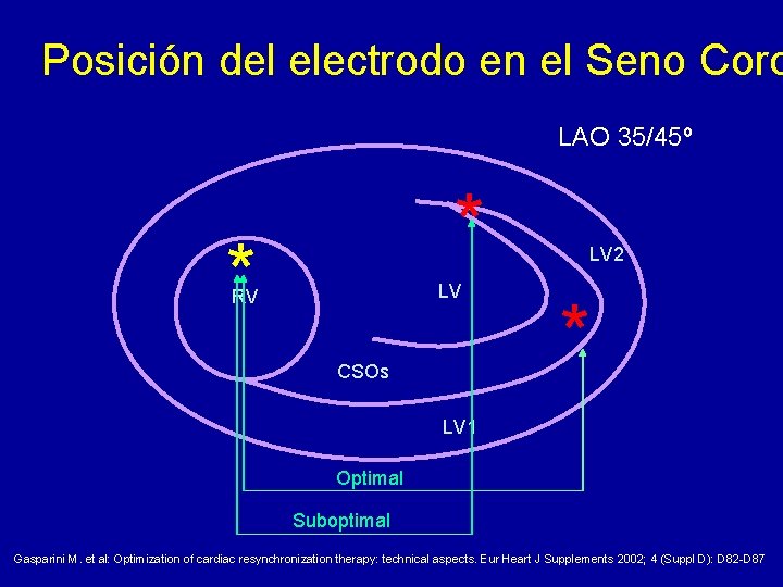 Posición del electrodo en el Seno Coro LAO 35/45º * * LV RV CSOs
