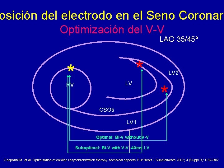 osición del electrodo en el Seno Coronari Optimización del V-V LAO 35/45º * LV