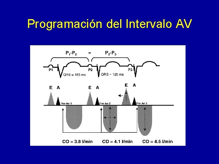 Programación del Intervalo AV 