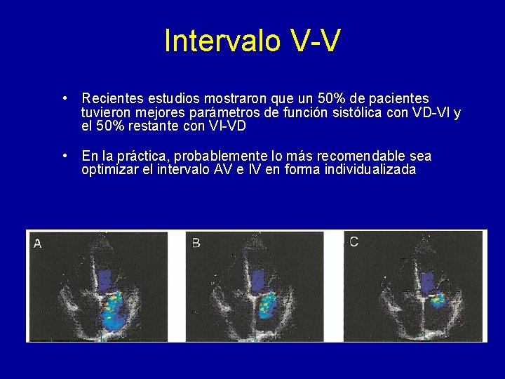Intervalo V-V • Recientes estudios mostraron que un 50% de pacientes tuvieron mejores parámetros