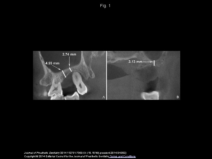 Fig. 1 Journal of Prosthetic Dentistry 2014 112731 -735 DOI: (10. 1016/j. prosdent. 2014.