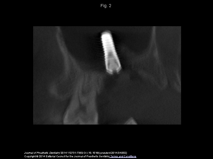 Fig. 2 Journal of Prosthetic Dentistry 2014 112731 -735 DOI: (10. 1016/j. prosdent. 2014.