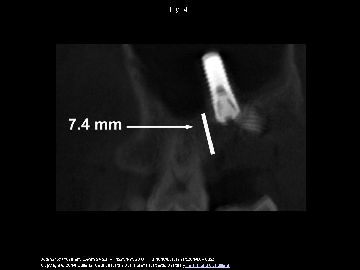 Fig. 4 Journal of Prosthetic Dentistry 2014 112731 -735 DOI: (10. 1016/j. prosdent. 2014.