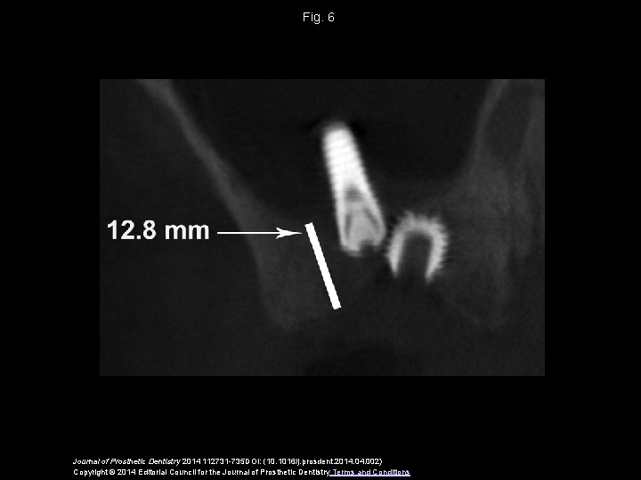 Fig. 6 Journal of Prosthetic Dentistry 2014 112731 -735 DOI: (10. 1016/j. prosdent. 2014.