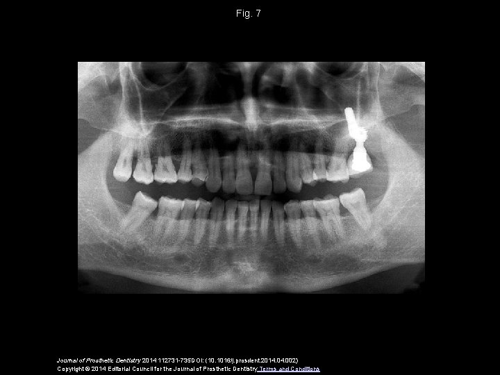 Fig. 7 Journal of Prosthetic Dentistry 2014 112731 -735 DOI: (10. 1016/j. prosdent. 2014.