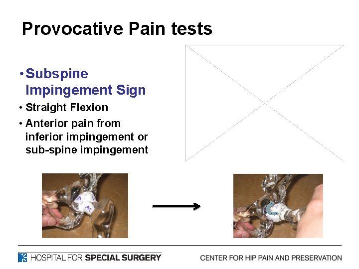 Provocative Pain tests • Subspine Impingement Sign • Straight Flexion • Anterior pain from