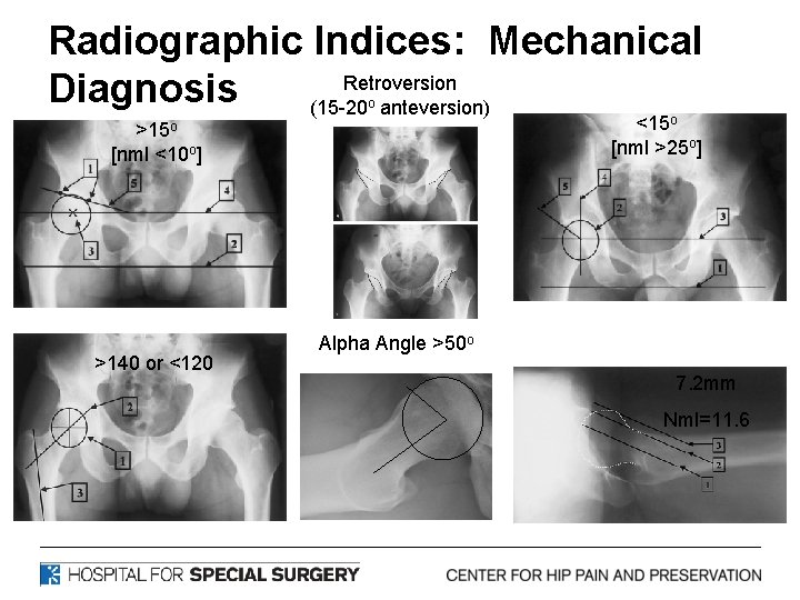 Radiographic Indices: Mechanical Retroversion Diagnosis (15 -20 anteversion) o <15 o [nml >25 o]