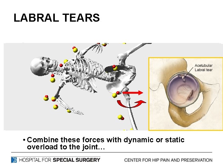 LABRAL TEARS • Combine these forces with dynamic or static overload to the joint…