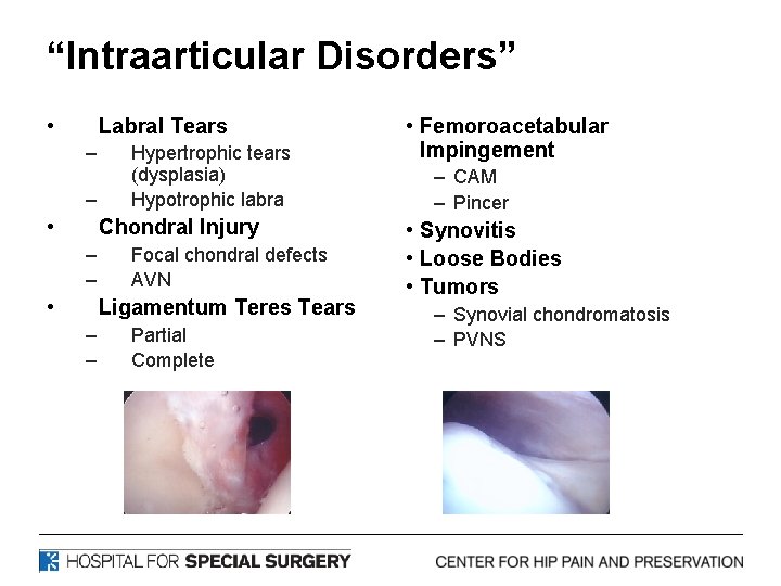 “Intraarticular Disorders” • Labral Tears – – • Hypertrophic tears (dysplasia) Hypotrophic labra Chondral