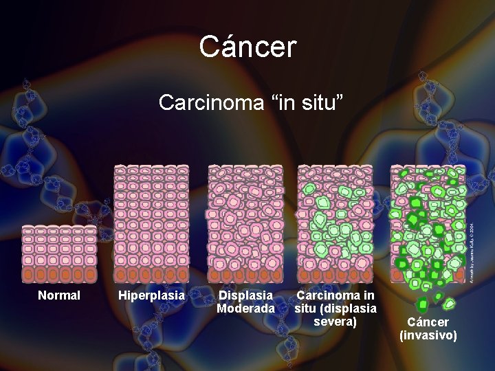 Cáncer Carcinoma “in situ” Normal Hiperplasia Displasia Moderada Carcinoma in situ (displasia severa) Cáncer Cáncer Carcinoma “in situ” Normal Hiperplasia Displasia Moderada Carcinoma in situ (displasia severa) Cáncer