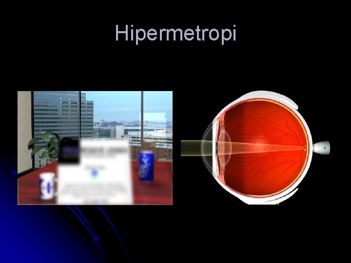 Hipermetropi 