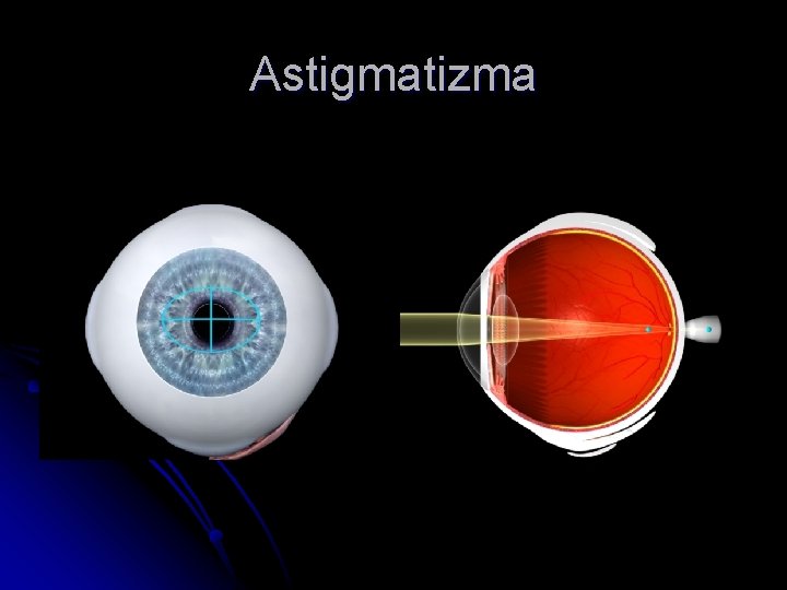 Astigmatizma 