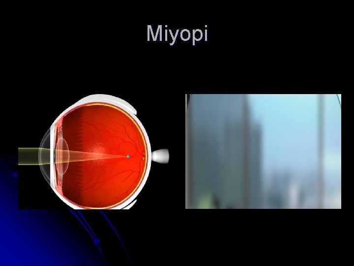 Miyopi 