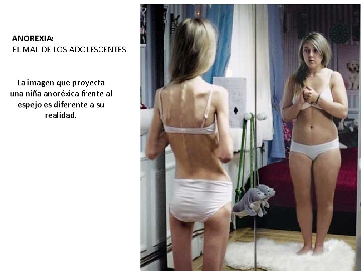 ANOREXIA: EL MAL DE LOS ADOLESCENTES La imagen que proyecta una niña anoréxica frente