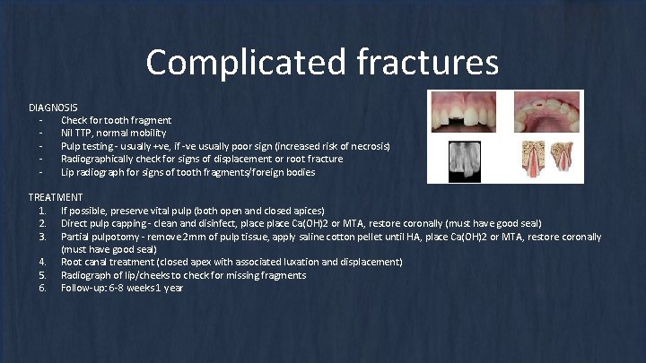 Complicated fractures DIAGNOSIS Check for tooth fragment Nil TTP, normal mobility Pulp testing - Complicated fractures DIAGNOSIS Check for tooth fragment Nil TTP, normal mobility Pulp testing -