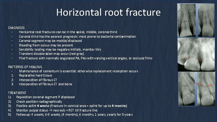 Horizontal root fracture DIAGNOSIS Horizontal root fractures can be in the apical, middle, coronal Horizontal root fracture DIAGNOSIS Horizontal root fractures can be in the apical, middle, coronal