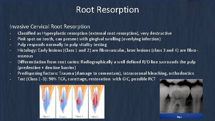 Root Resorption Invasive Cervical Root Resorption - Classified as Hyperplastic resorption (external root resorption), Root Resorption Invasive Cervical Root Resorption - Classified as Hyperplastic resorption (external root resorption),
