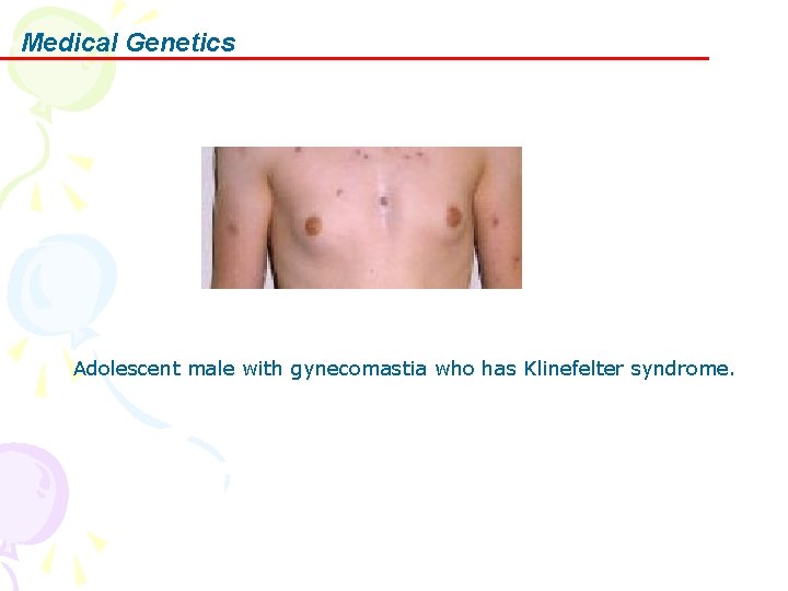 Medical Genetics Adolescent male with gynecomastia who has Klinefelter syndrome. 