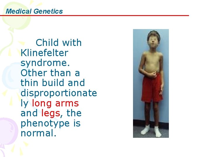 Medical Genetics Child with Klinefelter syndrome. Other than a thin build and disproportionate ly
