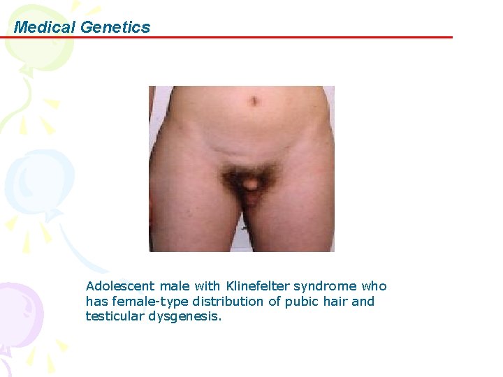 Medical Genetics Adolescent male with Klinefelter syndrome who has female-type distribution of pubic hair