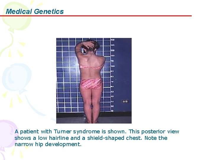 Medical Genetics A patient with Turner syndrome is shown. This posterior view shows a