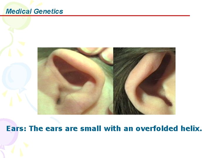 Medical Genetics Ears: The ears are small with an overfolded helix. 