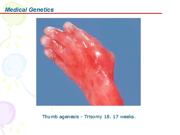 Medical Genetics Thumb agenesis - Trisomy 18. 17 weeks. 