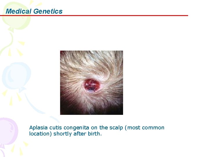 Medical Genetics Aplasia cutis congenita on the scalp (most common location) shortly after birth.