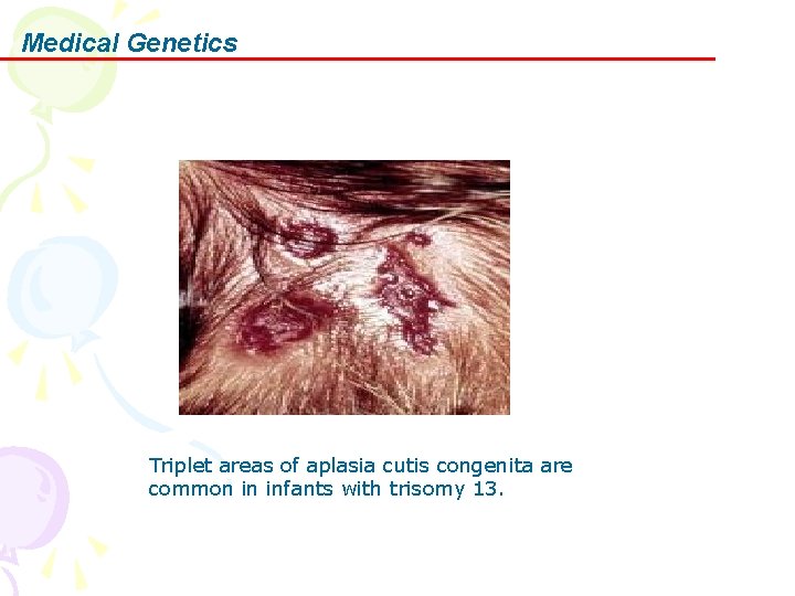 Medical Genetics Triplet areas of aplasia cutis congenita are common in infants with trisomy