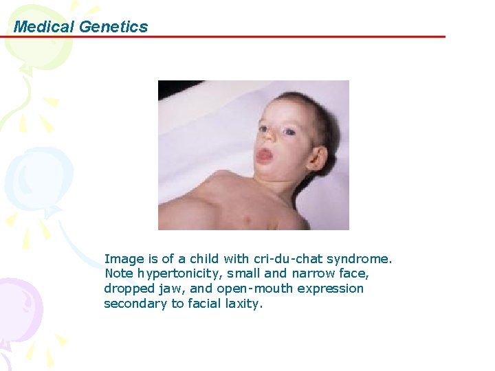 Medical Genetics Image is of a child with cri-du-chat syndrome. Note hypertonicity, small and