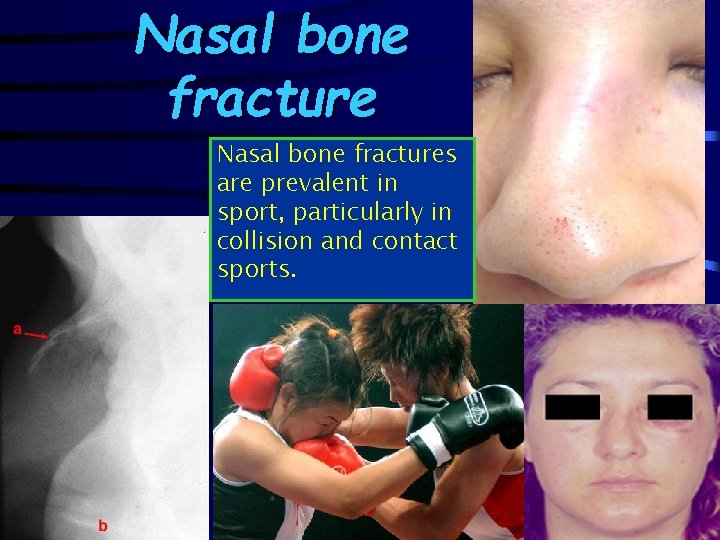 Nasal bone fractures are prevalent in sport, particularly in collision and contact sports. 