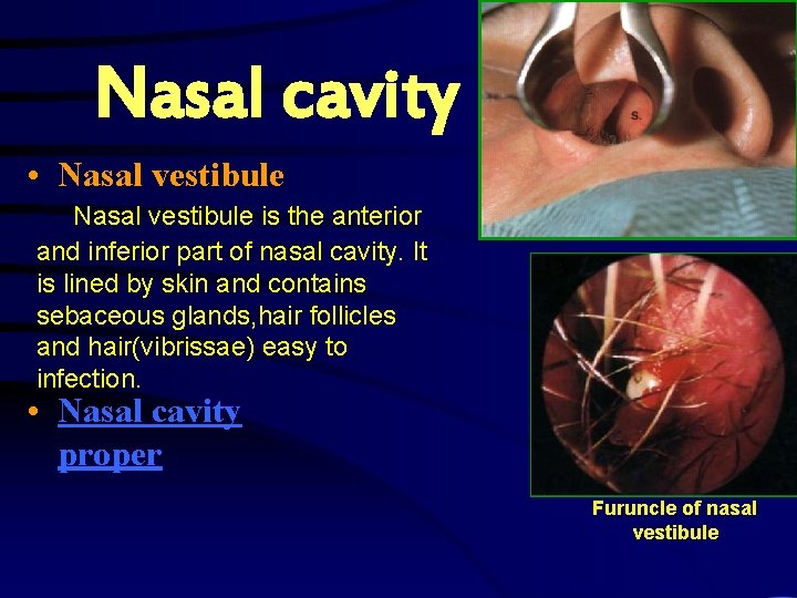 Nasal cavity • Nasal vestibule is the anterior and inferior part of nasal cavity.