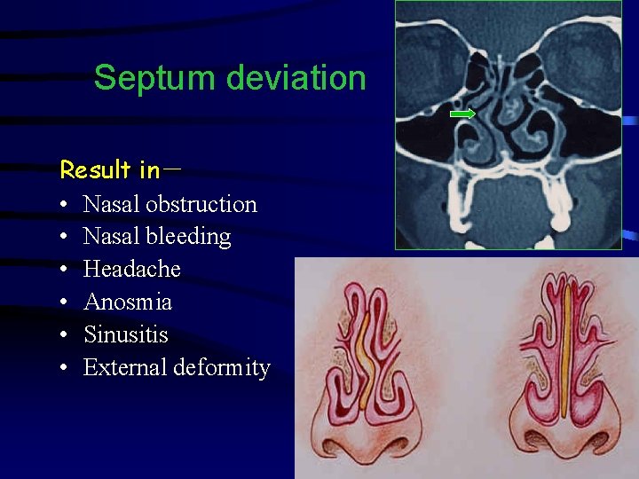 Septum deviation Result in－ • Nasal obstruction • Nasal bleeding • Headache • Anosmia
