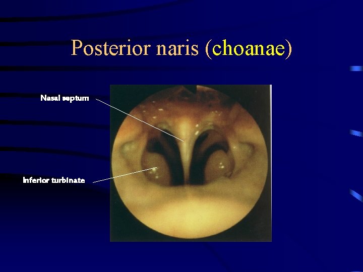 Posterior naris (choanae) Nasal septum Inferior turbinate 