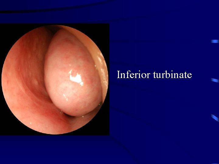 Inferior turbinate 