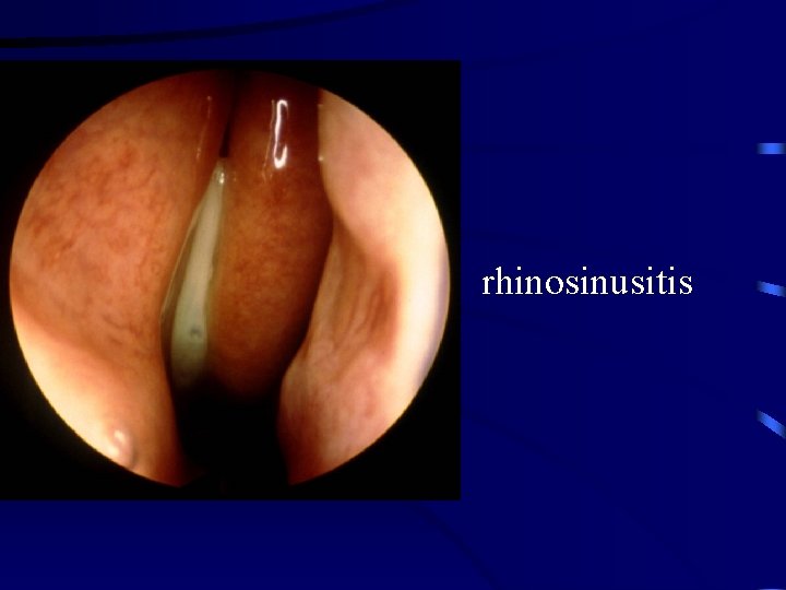 rhinosinusitis 