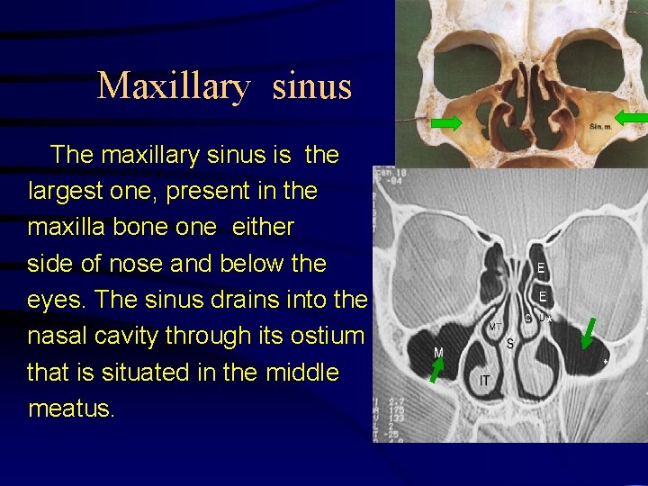 Maxillary sinus The maxillary sinus is the largest one, present in the maxilla bone