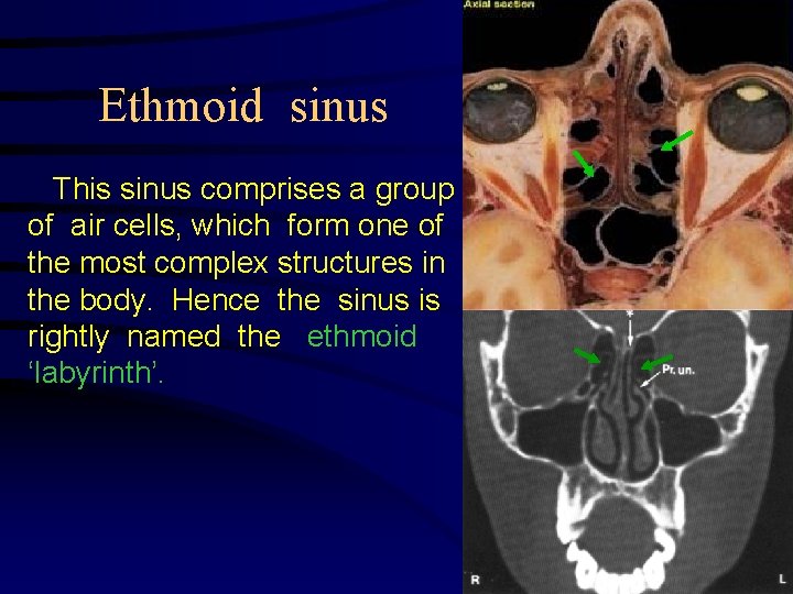 Ethmoid sinus This sinus comprises a group of air cells, which form one of