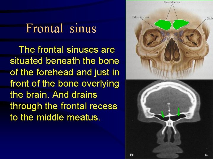 Frontal sinus The frontal sinuses are situated beneath the bone of the forehead and