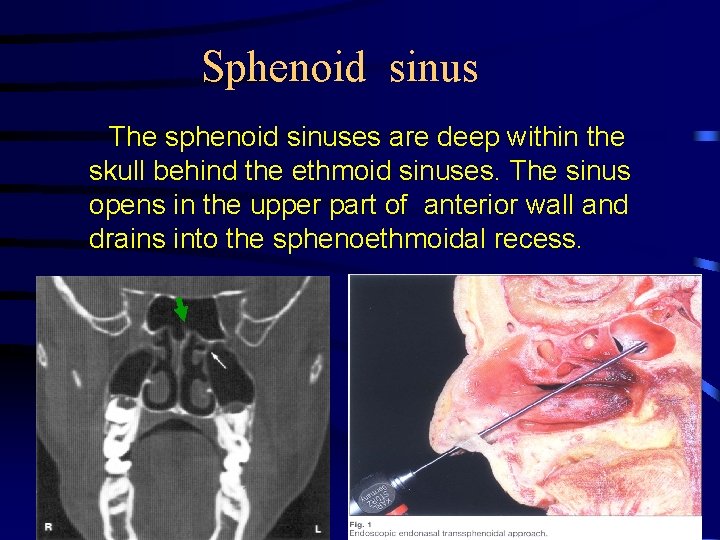 Sphenoid sinus The sphenoid sinuses are deep within the skull behind the ethmoid sinuses.