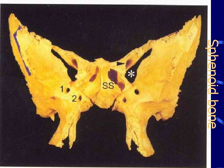 Sphenoid bone 