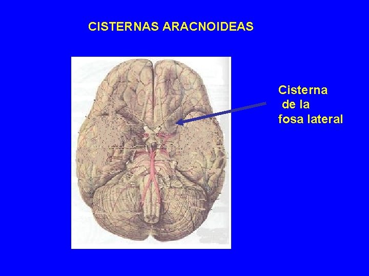 CISTERNAS ARACNOIDEAS Cisterna de la fosa lateral CISTERNAS ARACNOIDEAS Cisterna de la fosa lateral