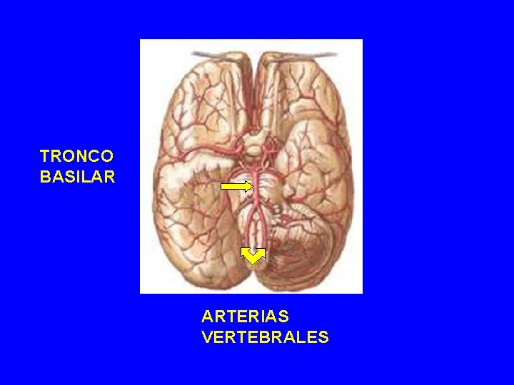 TRONCO BASILAR ARTERIAS VERTEBRALES TRONCO BASILAR ARTERIAS VERTEBRALES