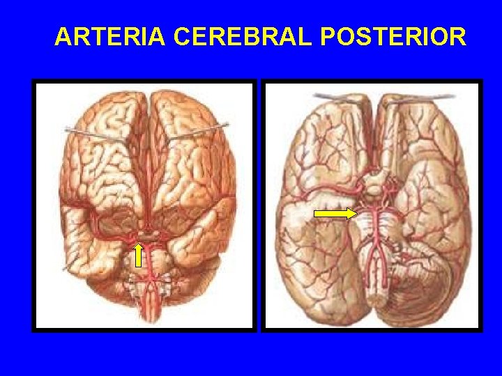 ARTERIA CEREBRAL POSTERIOR ARTERIA CEREBRAL POSTERIOR