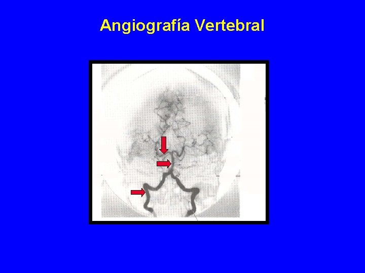 Angiografía Vertebral Angiografía Vertebral