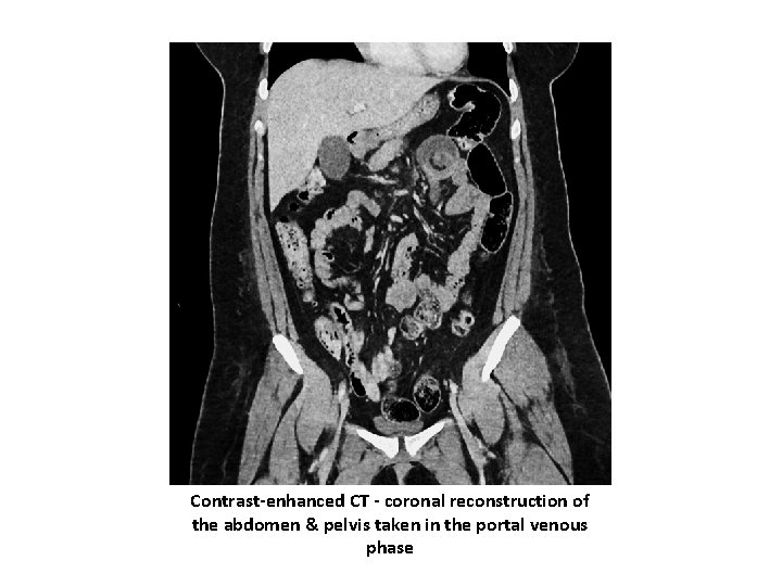 Contrast-enhanced CT - coronal reconstruction of the abdomen & pelvis taken in the portal