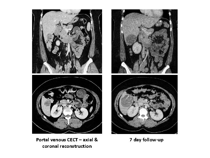 Portal venous CECT – axial & coronal reconstruction 7 day follow-up 