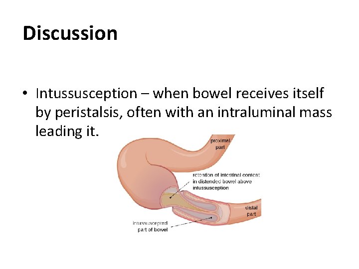 Discussion • Intussusception – when bowel receives itself by peristalsis, often with an intraluminal